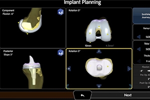 How Robotic-Assisted Surgery Is Revolutionizing Knee Arthritis Treatment
