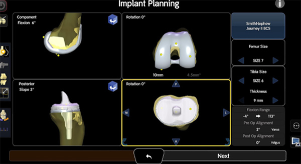 How Robotic-Assisted Surgery Is Revolutionizing Knee Arthritis Treatment