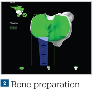 Bone Preparation