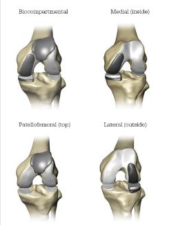 Mako Smartrobotics Partial Knee Replacement