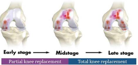Total Knee vs. Partial Knee Replacement