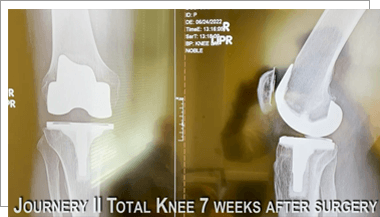 Rapid recovery with Same Day Journey II Total Knee Replacement