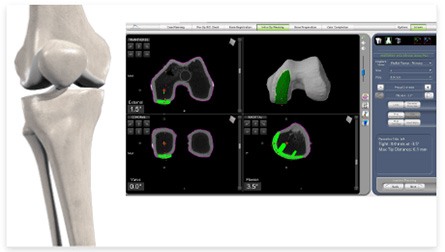 SmartRobotics Partial Knee1