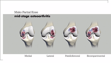 Partial Knee Robotic Assisted Surgery Mako