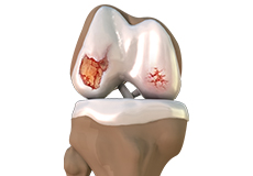 Osteoarthritis of the Knee